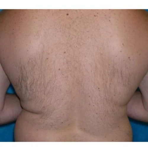 Laser hair removal treatment results | Isya Aesthetics in Vasant Vihar, New Delhi