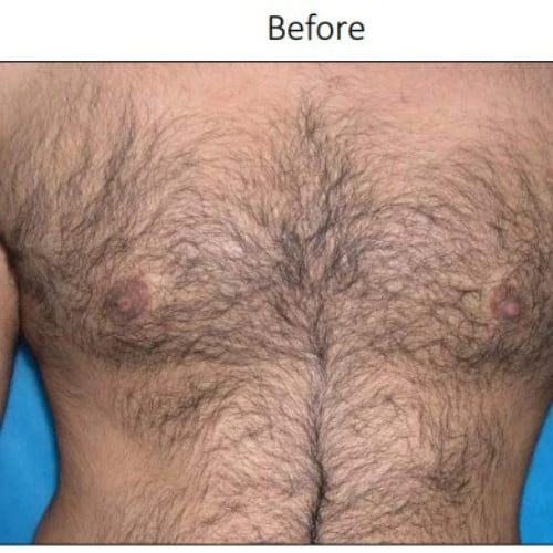 Before Laser hair removal treatment | Isya Aesthetics in Vasant Vihar, New Delhi