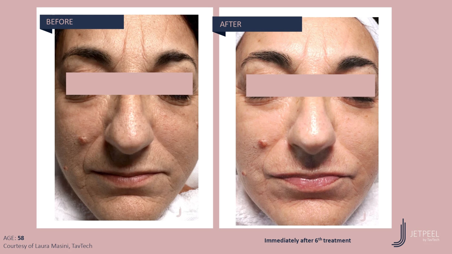 Anti Aging before and after effect | Isya Aesthetics | Vasant Vihar, New Delhi