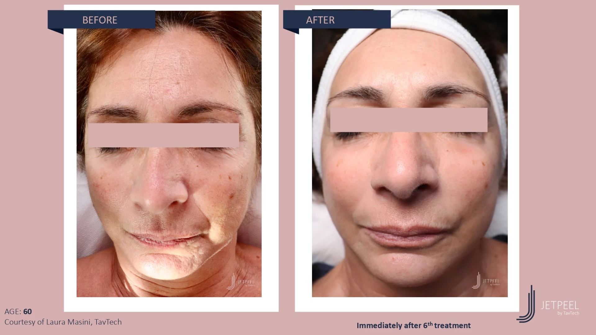 Anti Aging before and after effect | Isya Aesthetics | Vasant Vihar, New Delhi