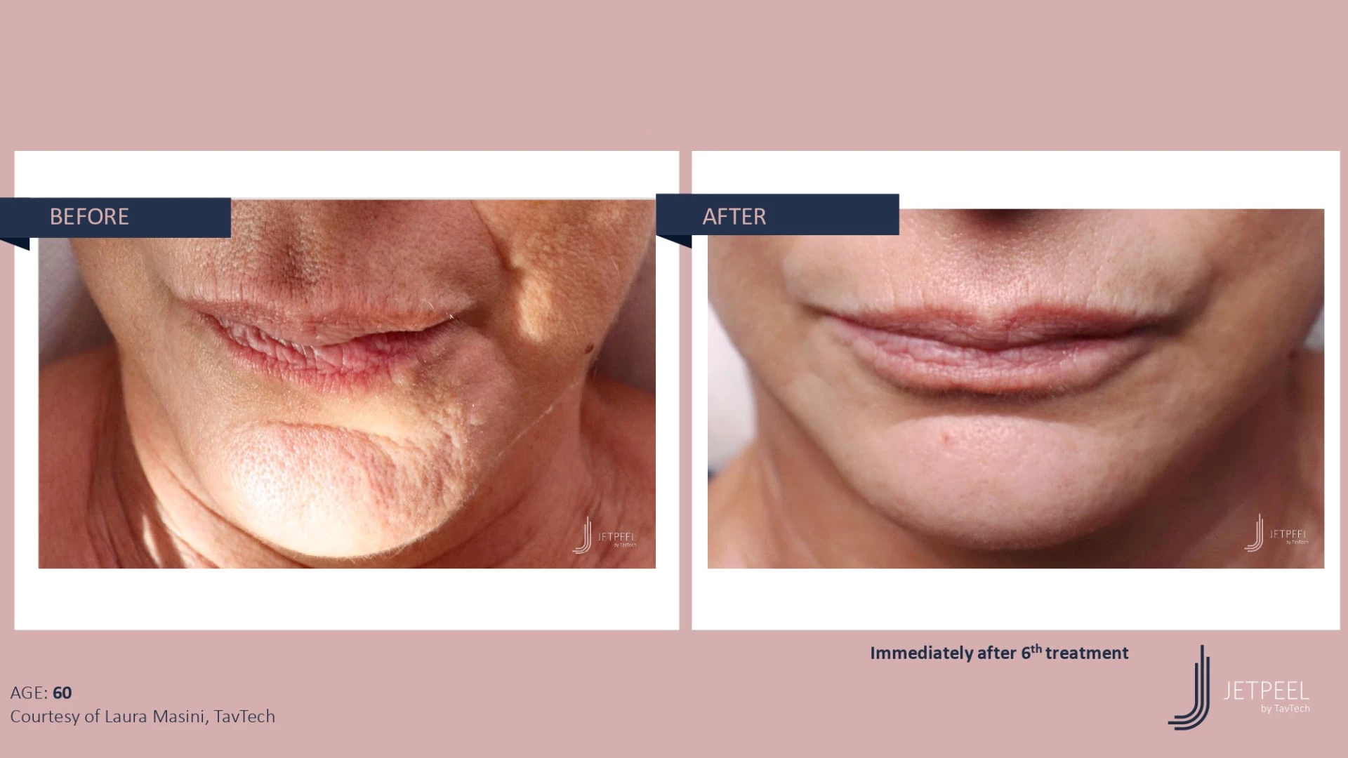 Anti Aging before and after effect | Isya Aesthetics | Vasant Vihar, New Delhi