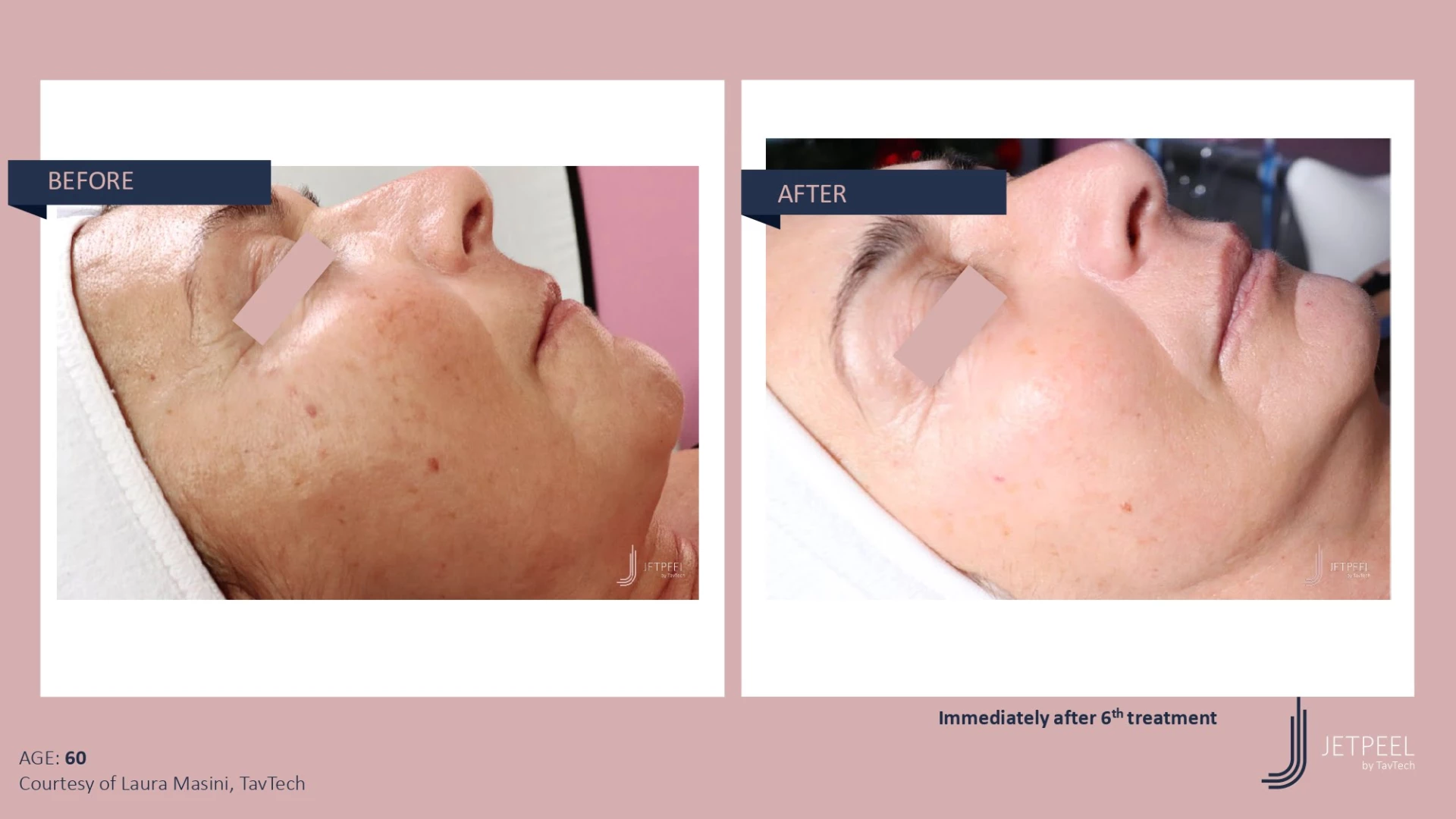 Anti Aging before and after effect | Isya Aesthetics | Vasant Vihar, New Delhi