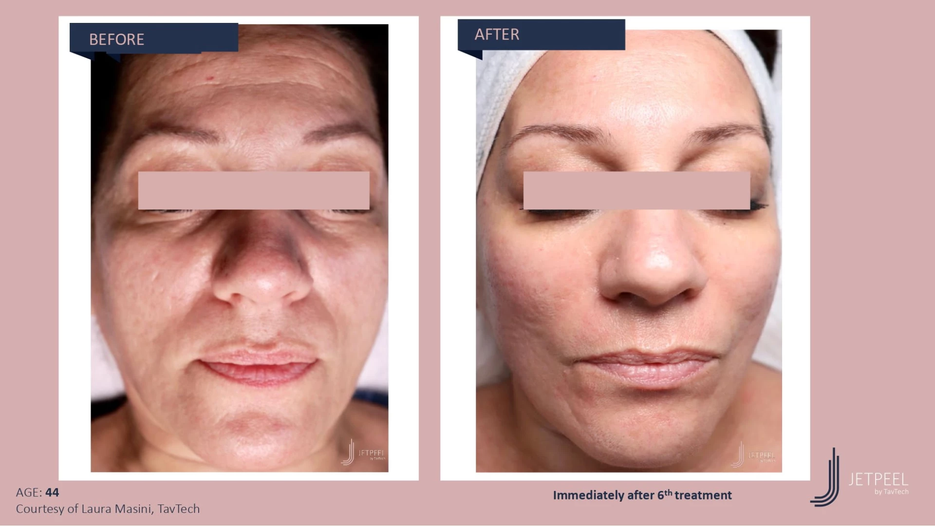 Anti Aging before and after effect | Isya Aesthetics | Vasant Vihar, New Delhi