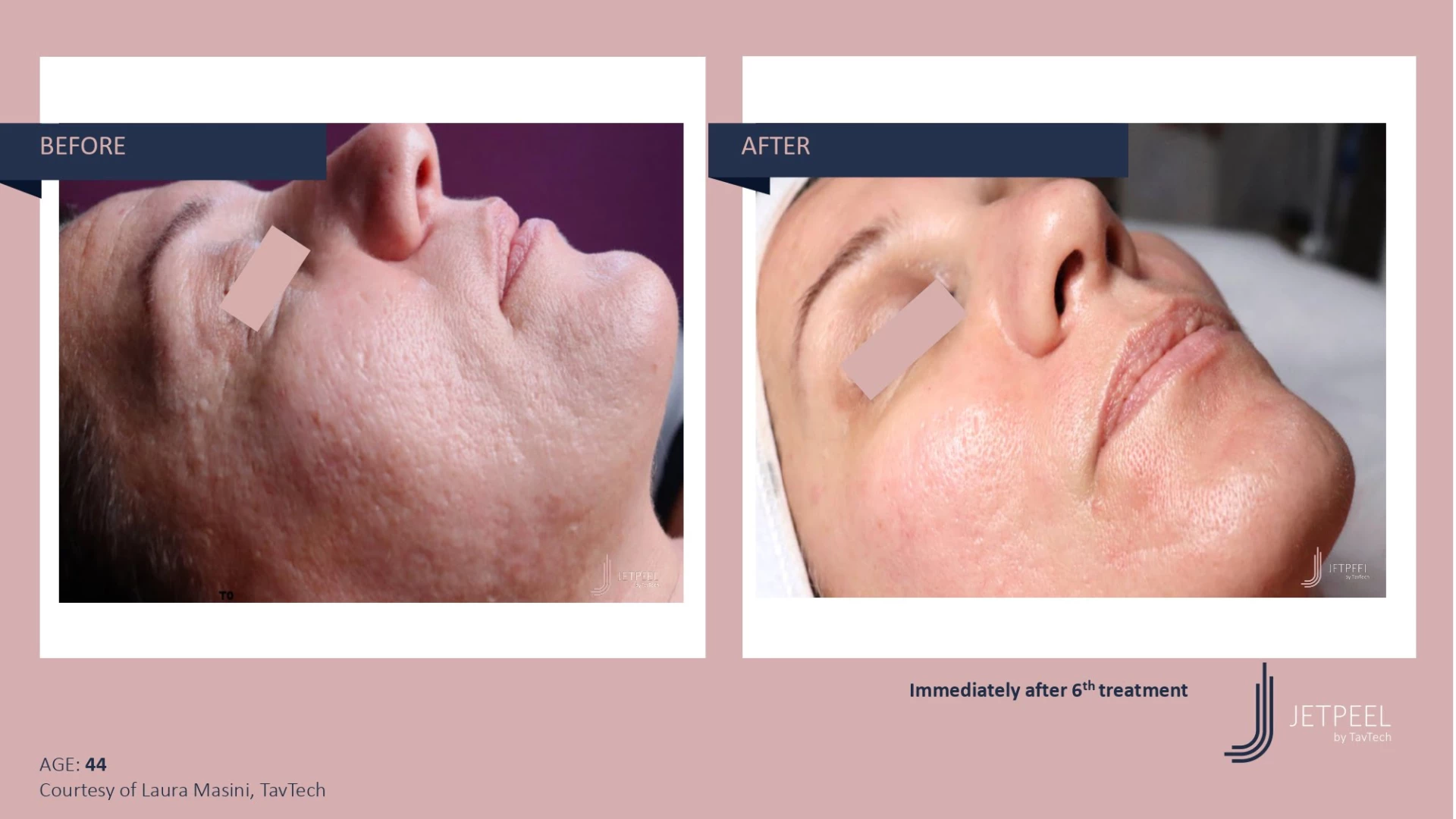 Anti Aging before and after effect | Isya Aesthetics | Vasant Vihar, New Delhi