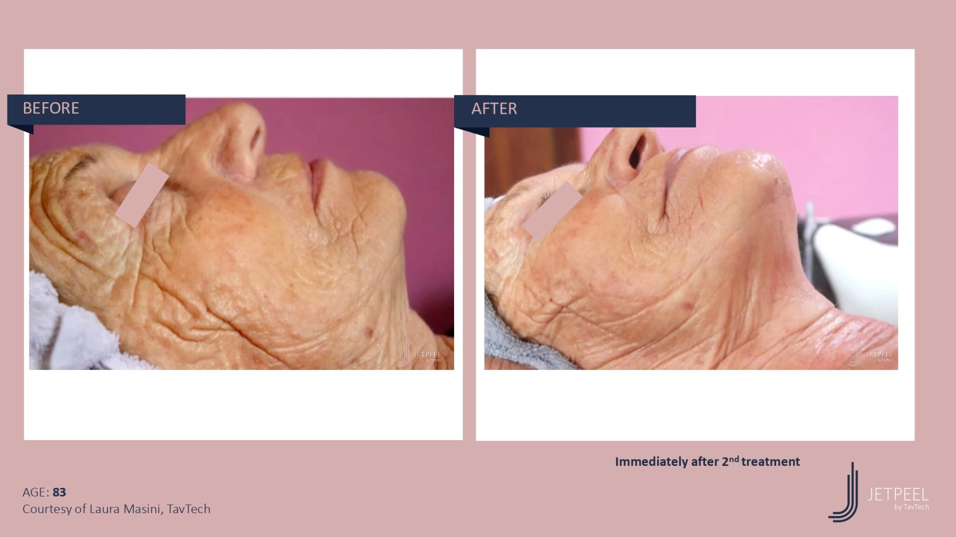 Anti Aging before and after effect | Isya Aesthetics | Vasant Vihar, New Delhi