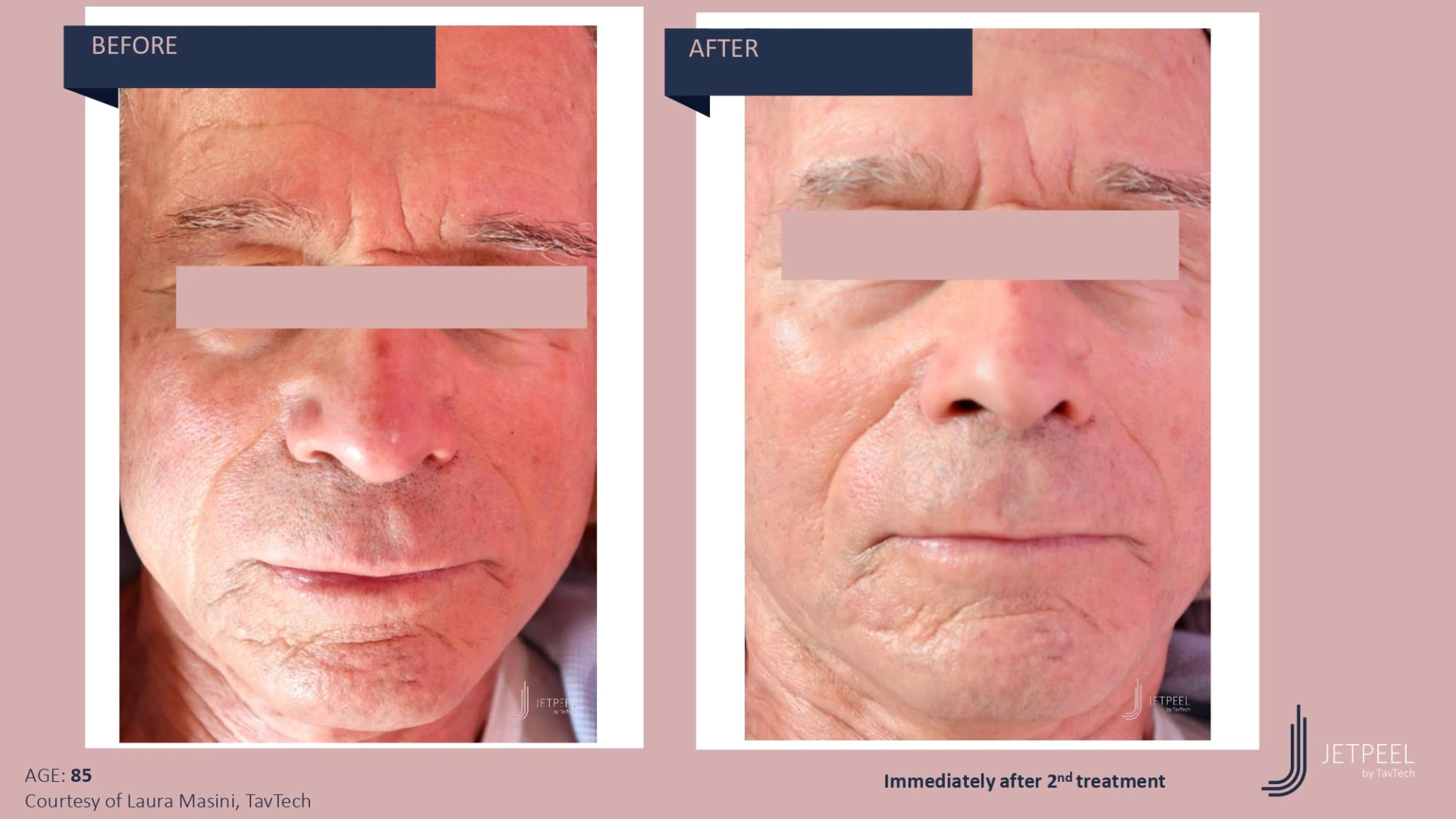 Anti Aging before and after effect | Isya Aesthetics | Vasant Vihar, New Delhi