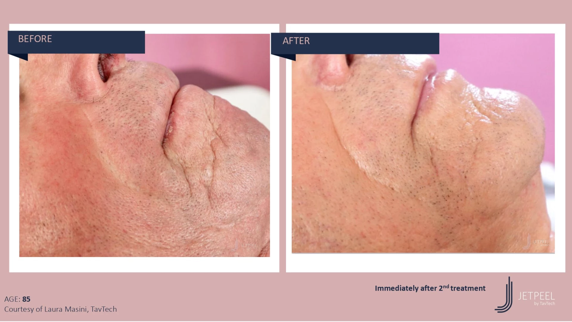 Anti Aging before and after effect | Isya Aesthetics | Vasant Vihar, New Delhi