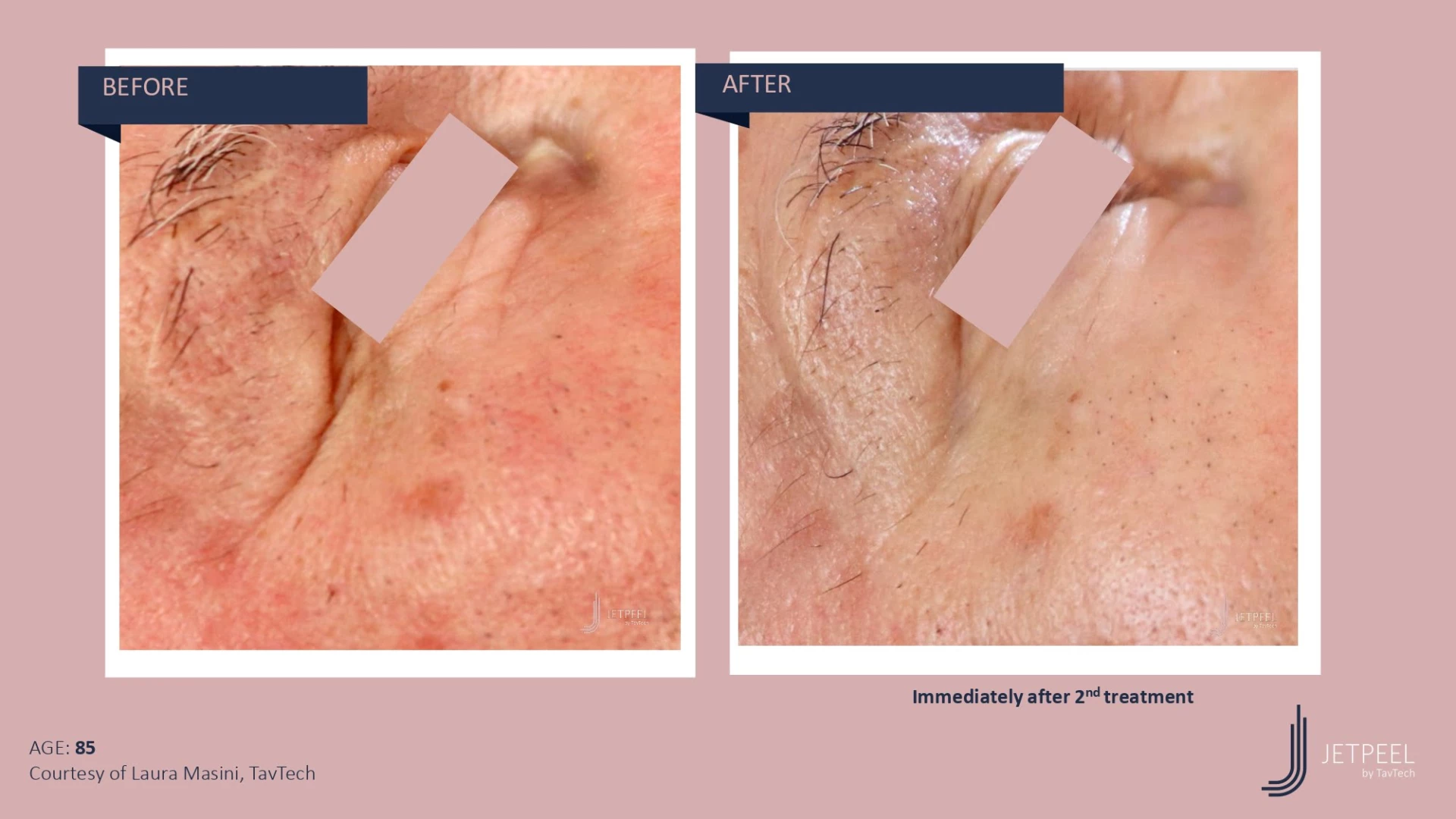 Anti Aging before and after effect | Isya Aesthetics | Vasant Vihar, New Delhi