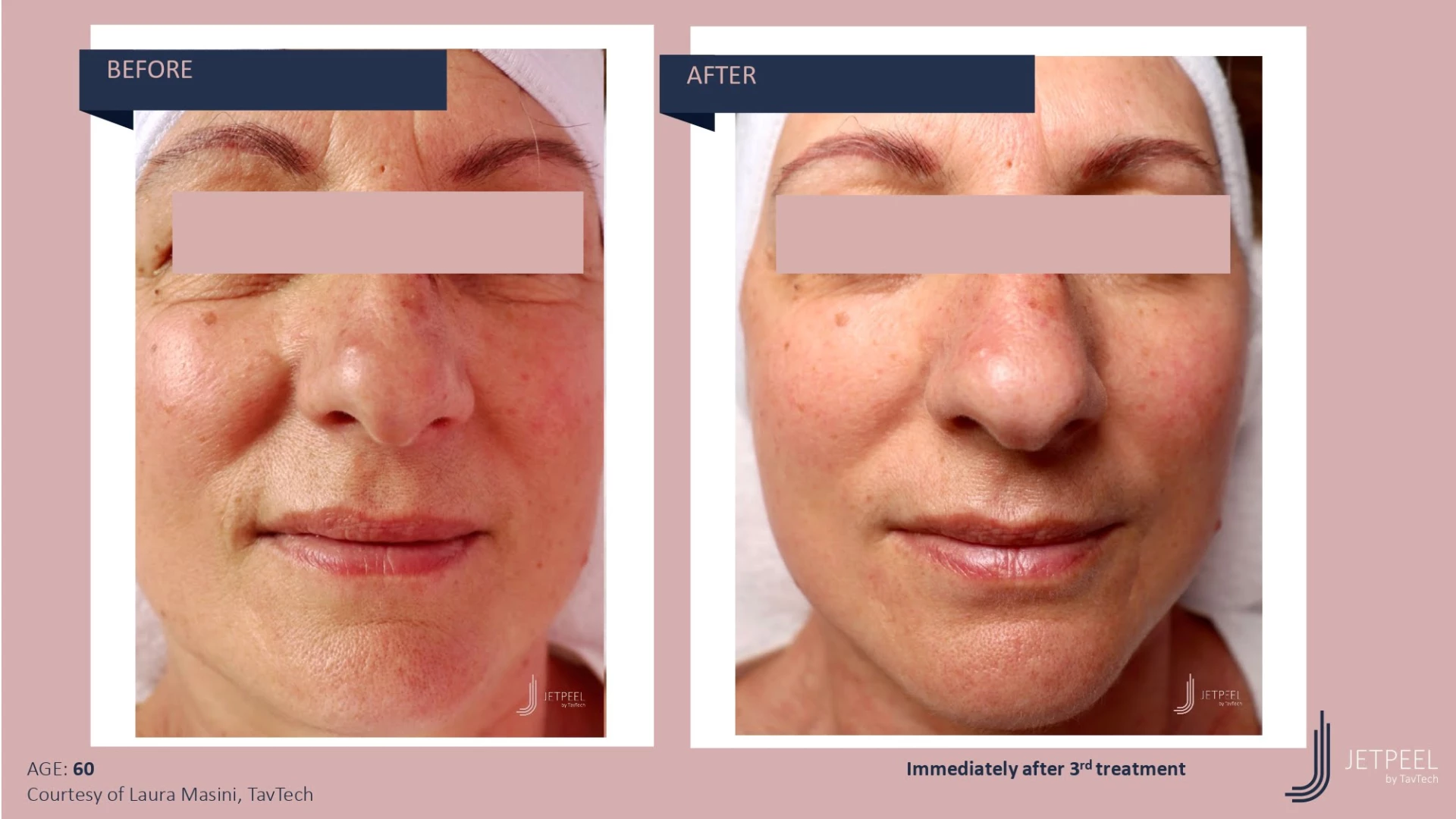 Anti Aging before and after effect | Isya Aesthetics | Vasant Vihar, New Delhi