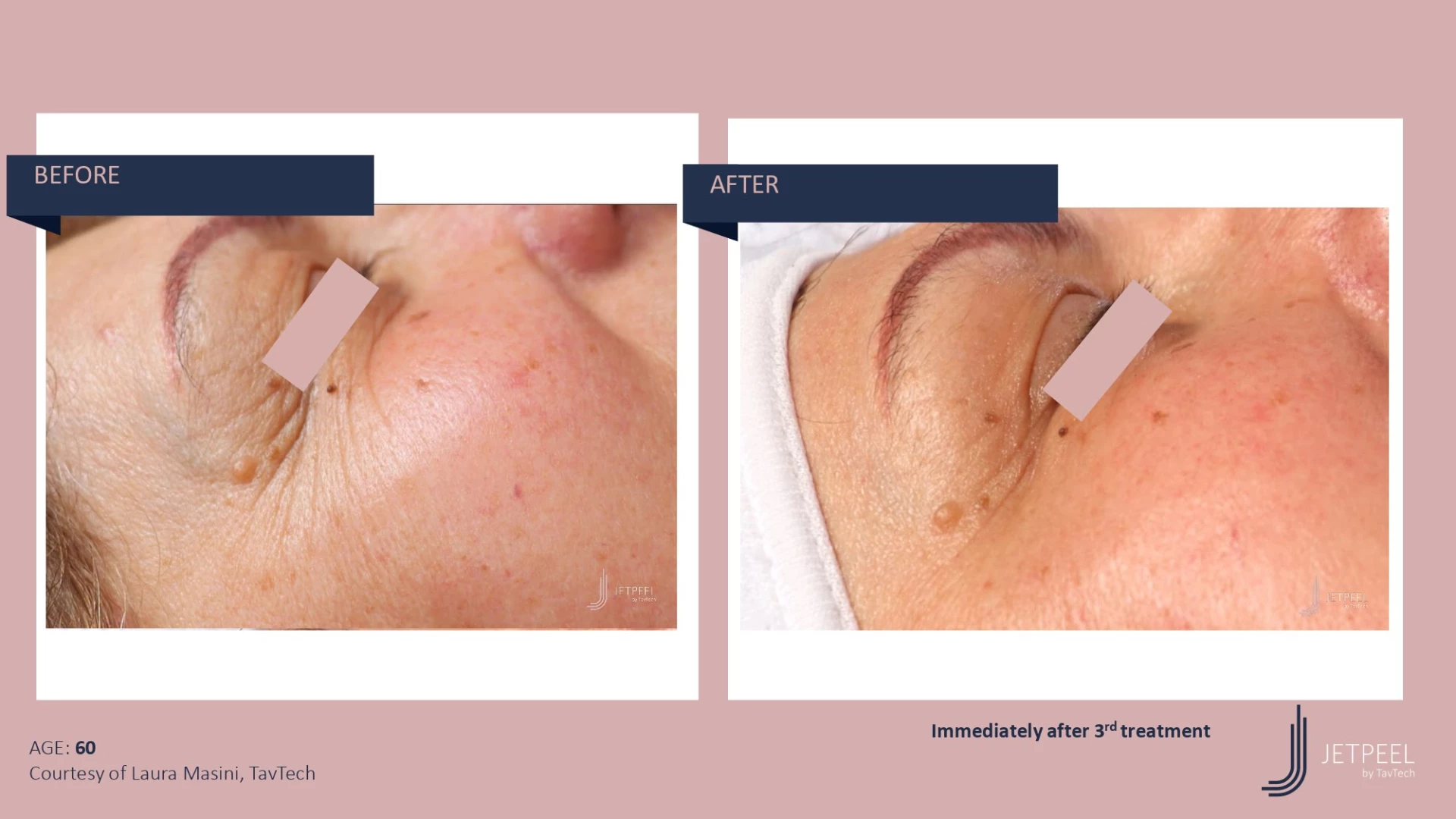 Anti Aging before and after effect | Isya Aesthetics | Vasant Vihar, New Delhi