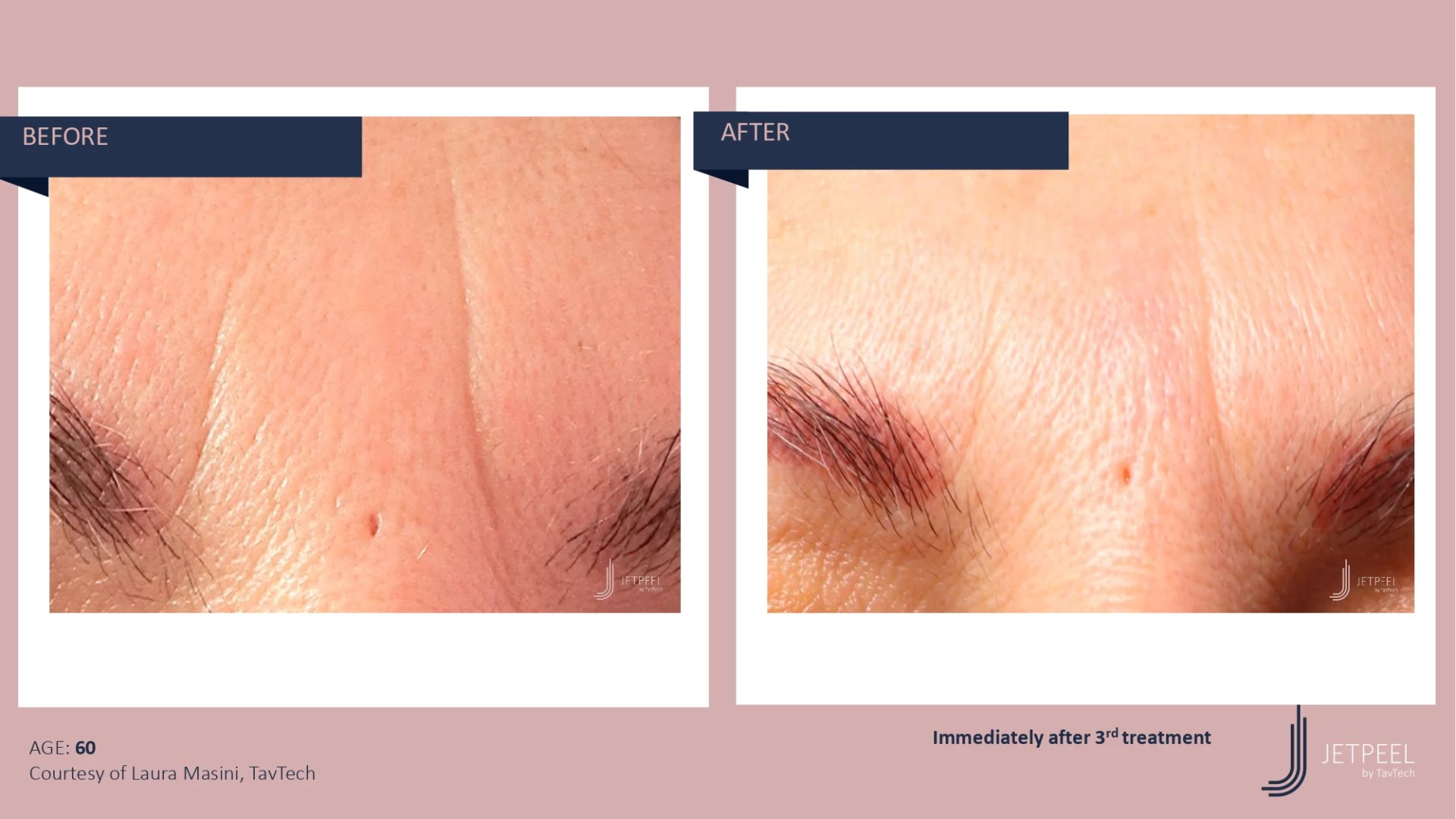 Anti Aging before and after effect | Isya Aesthetics | Vasant Vihar, New Delhi