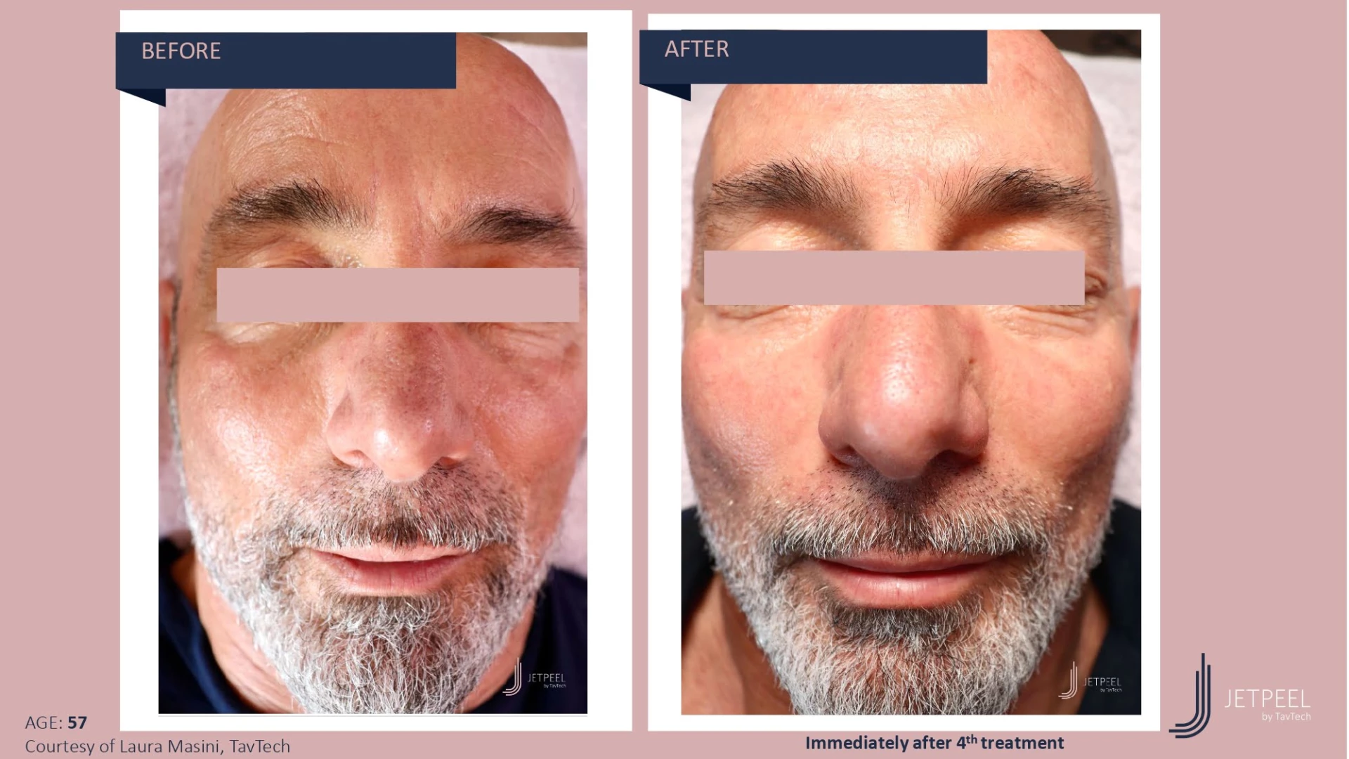 Anti Aging before and after effect | Isya Aesthetics | Vasant Vihar, New Delhi