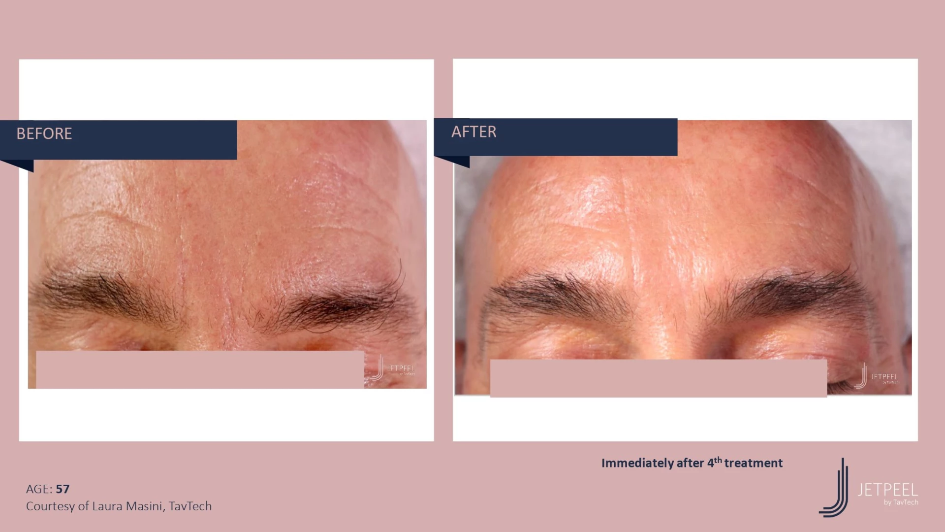 Anti Aging before and after effect | Isya Aesthetics | Vasant Vihar, New Delhi