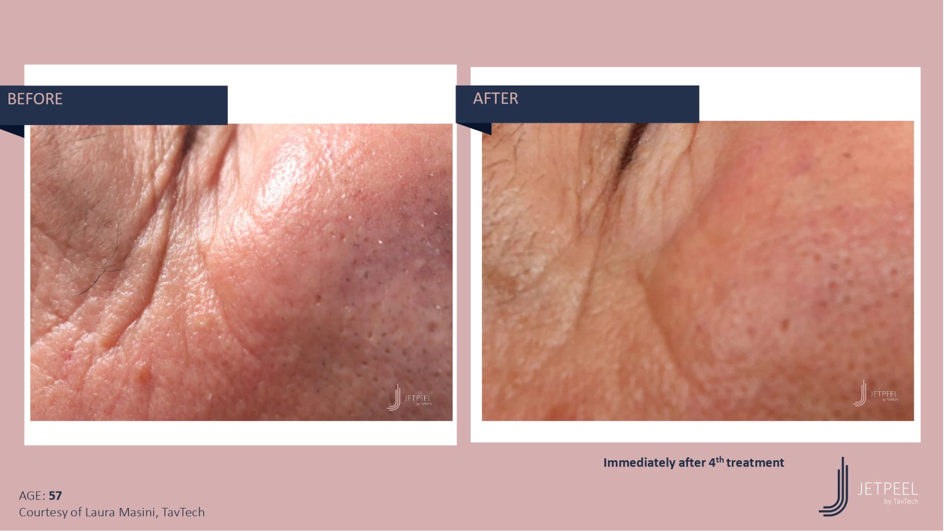 Anti Aging before and after effect | Isya Aesthetics | Vasant Vihar, New Delhi