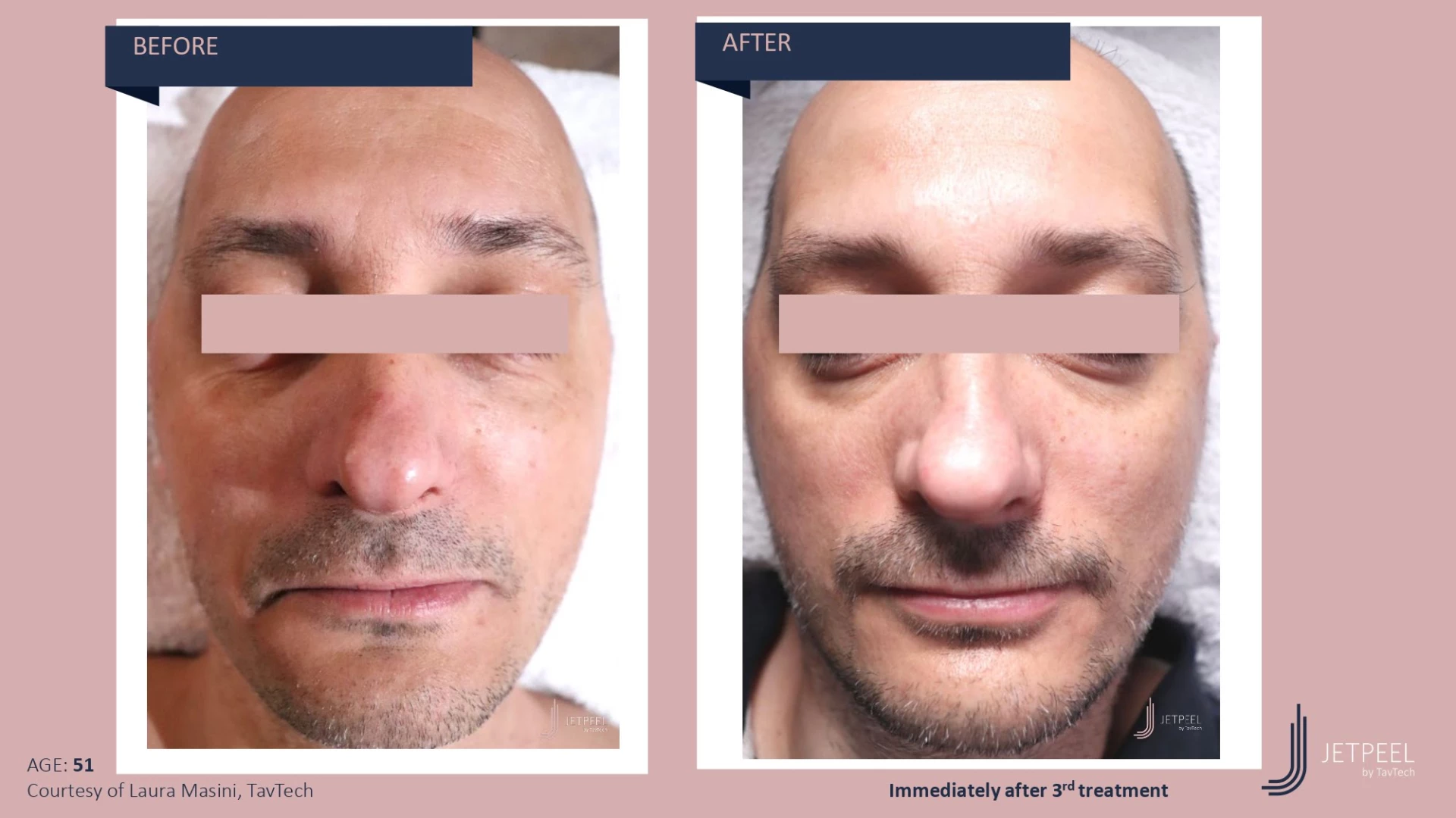 Anti Aging before and after effect | Isya Aesthetics | Vasant Vihar, New Delhi