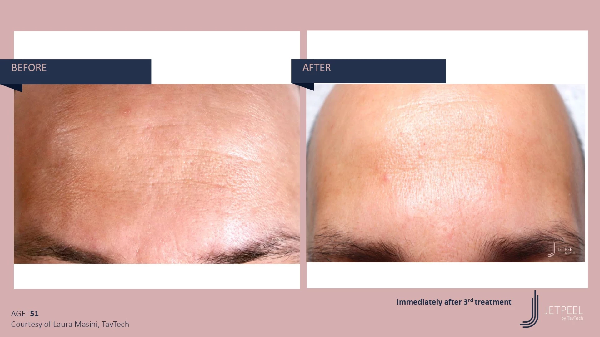 Anti Aging before and after effect | Isya Aesthetics | Vasant Vihar, New Delhi