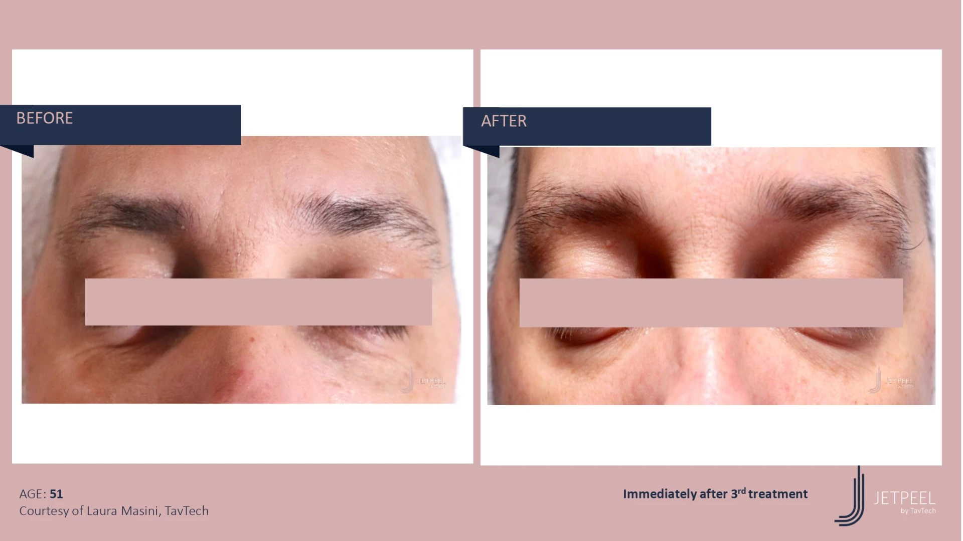 Anti Aging before and after effect | Isya Aesthetics | Vasant Vihar, New Delhi