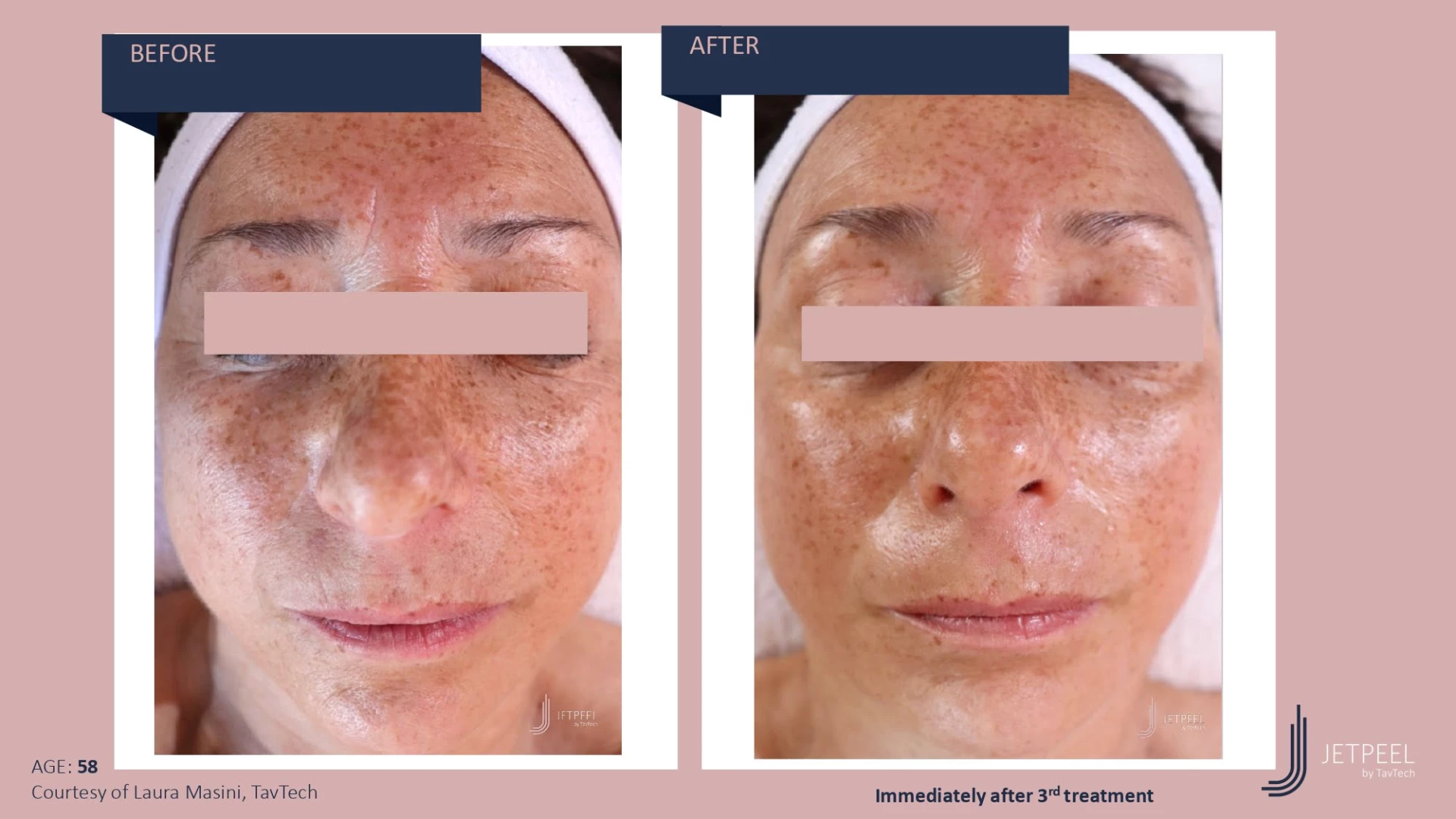 Anti Aging before and after effect | Isya Aesthetics | Vasant Vihar, New Delhi