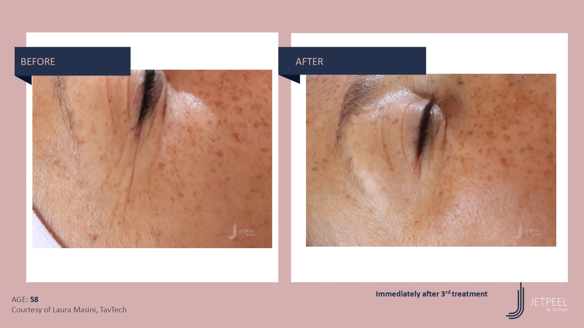 Anti Aging before and after effect | Isya Aesthetics | Vasant Vihar, New Delhi