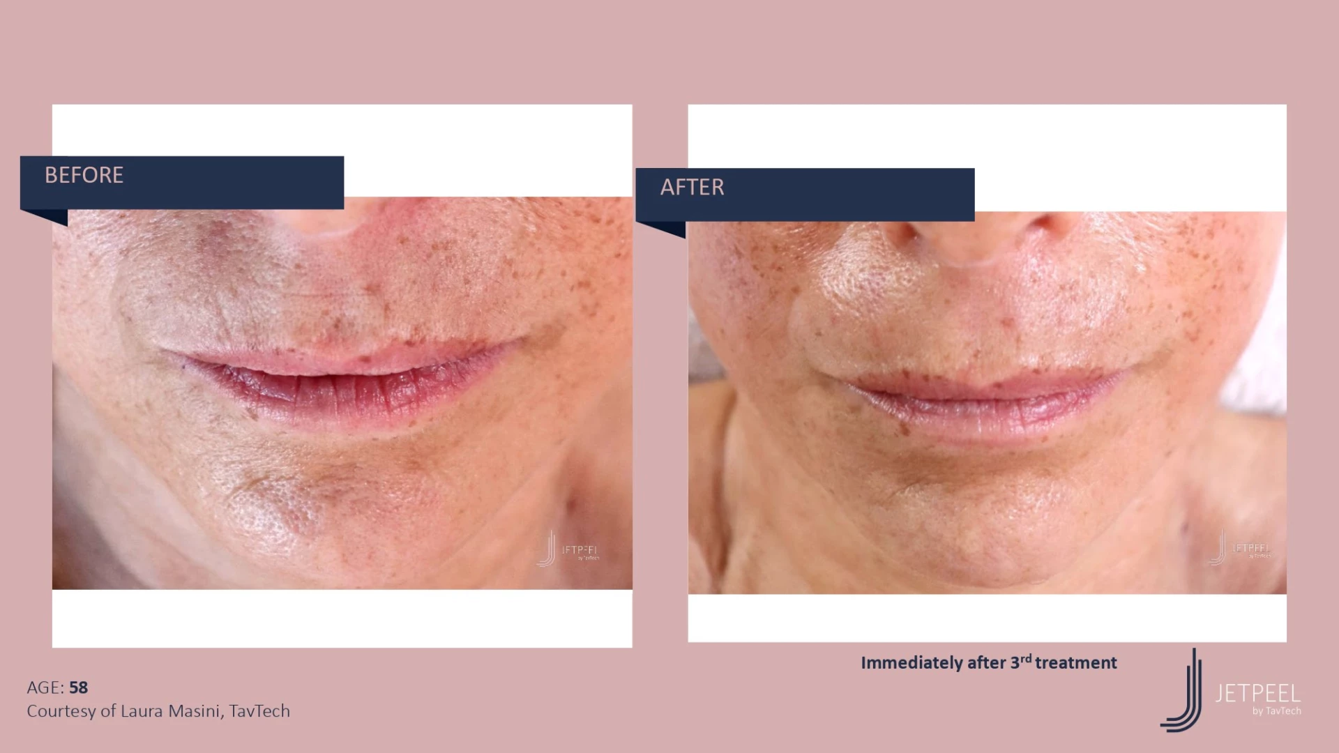 Anti Aging before and after effect | Isya Aesthetics | Vasant Vihar, New Delhi