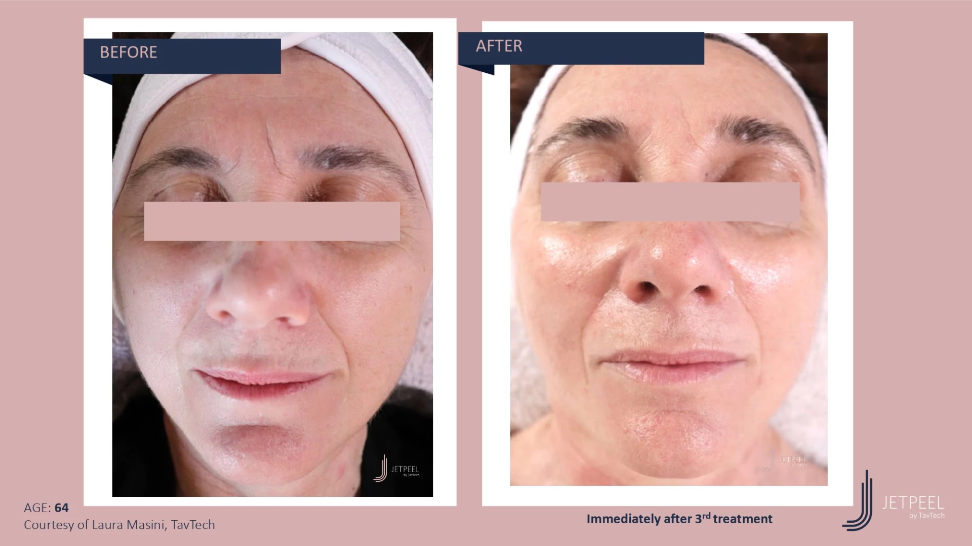 Anti Aging before and after effect | Isya Aesthetics | Vasant Vihar, New Delhi