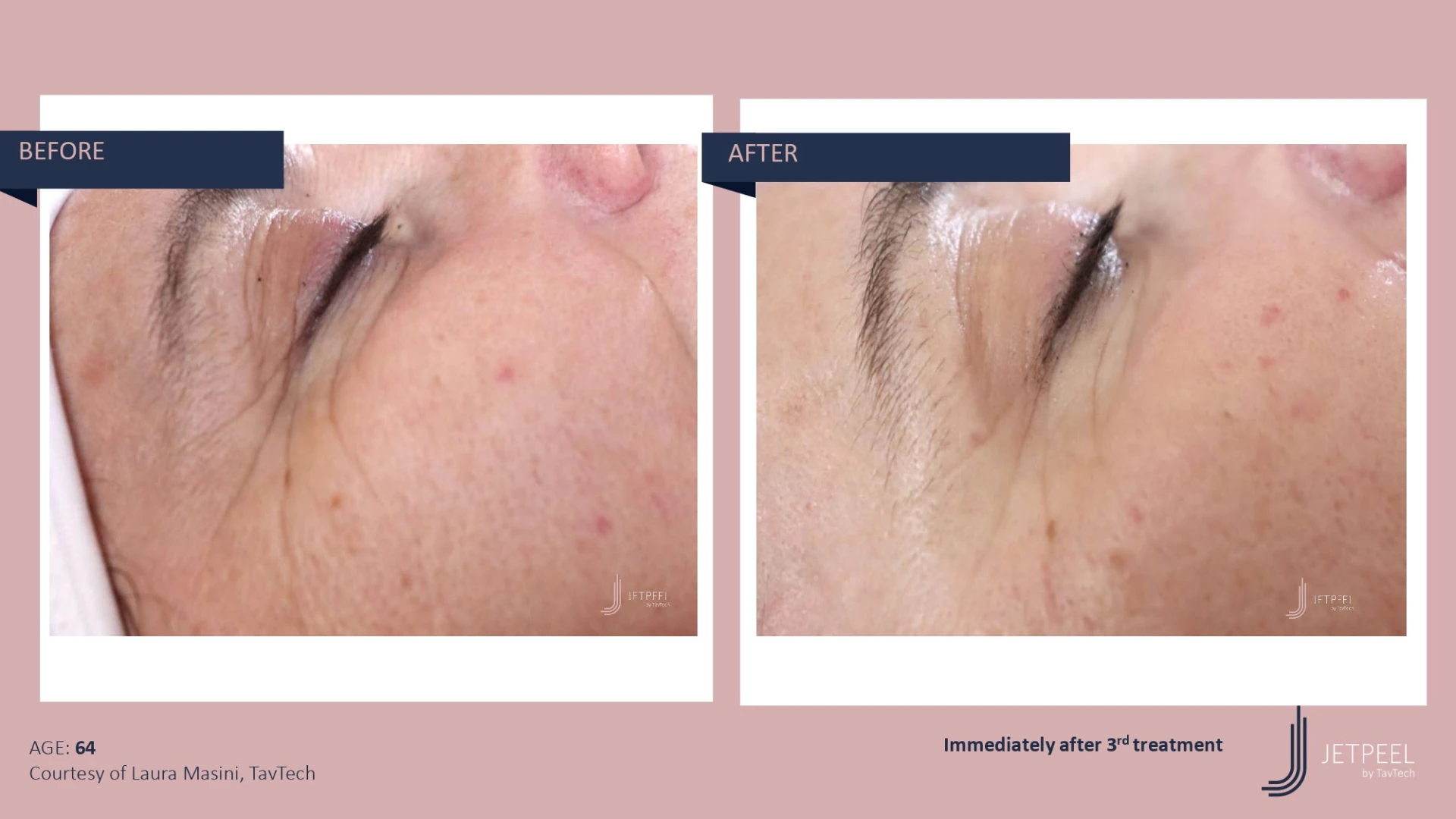 Anti Aging before and after effect | Isya Aesthetics | Vasant Vihar, New Delhi