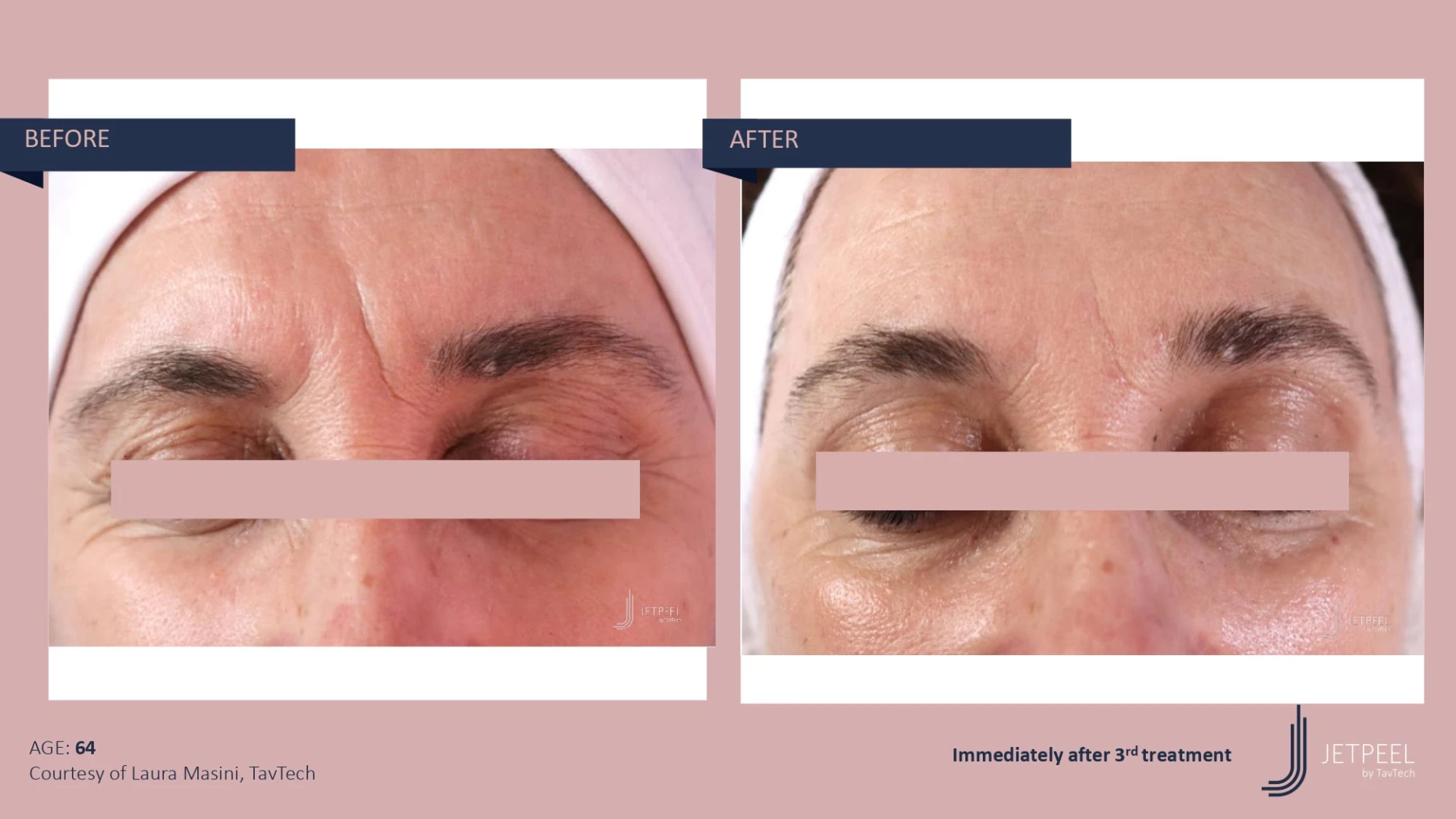 Anti Aging before and after effect | Isya Aesthetics | Vasant Vihar, New Delhi