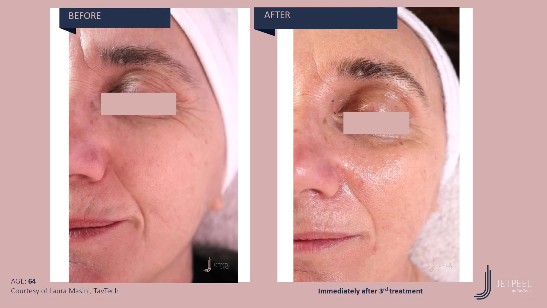 Anti Aging before and after effect | Isya Aesthetics | Vasant Vihar, New Delhi