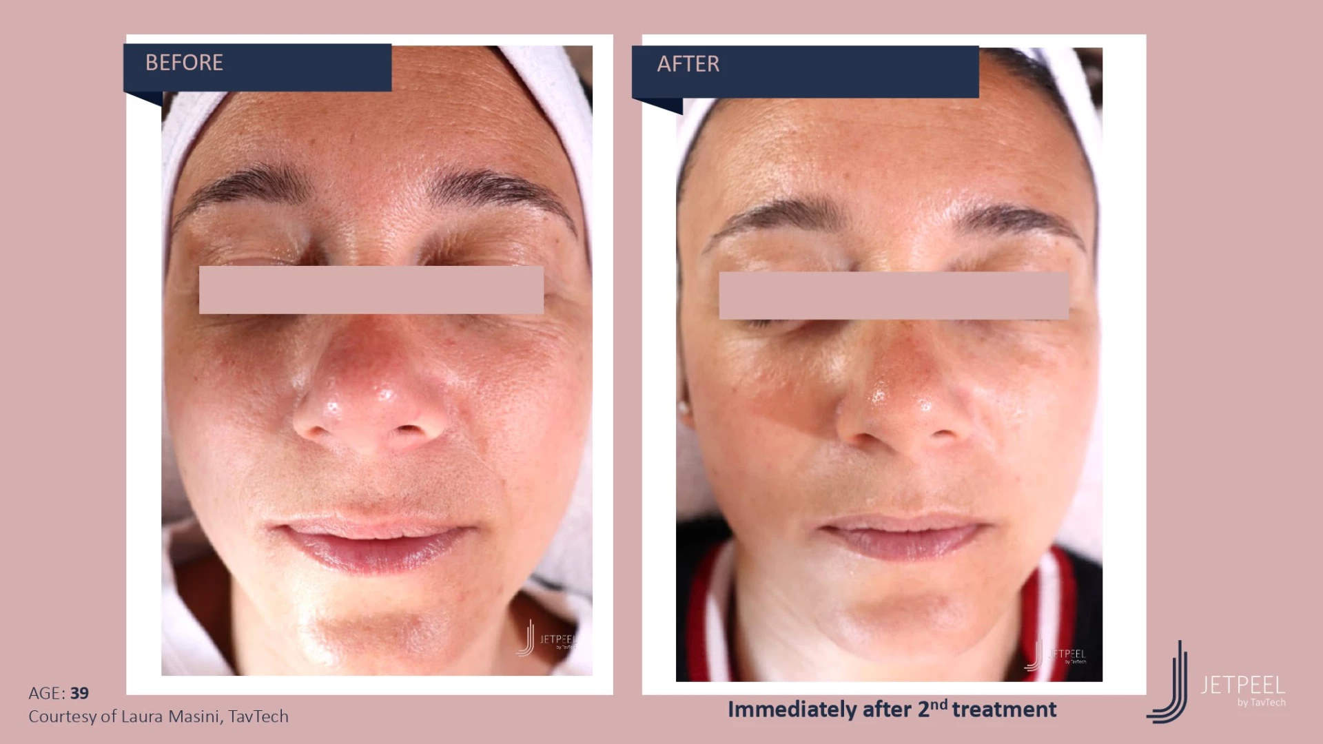 Anti Aging before and after effect | Isya Aesthetics | Vasant Vihar, New Delhi