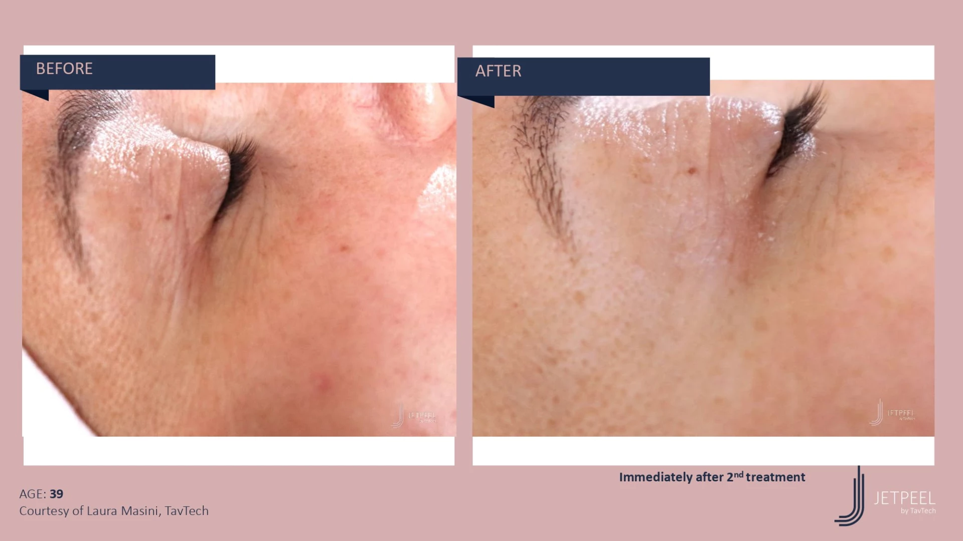 Anti Aging before and after effect | Isya Aesthetics | Vasant Vihar, New Delhi