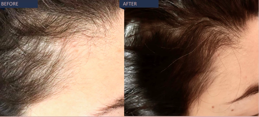 Before and after effect hair growth | Isya Aesthetics | Vasant Vihar, New Delhi
