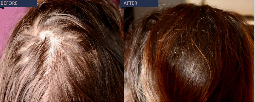 Before and after effect hair growth | Isya Aesthetics | Vasant Vihar, New Delhi