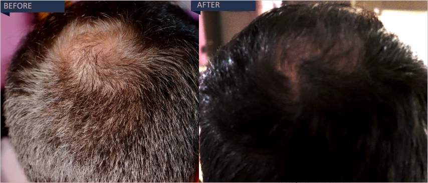 Before and after effect hair growth | Isya Aesthetics | Vasant Vihar, New Delhi