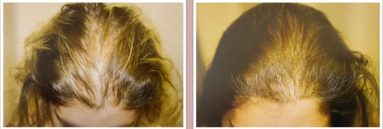 Before and after effect hair growth | Isya Aesthetics | Vasant Vihar, New Delhi