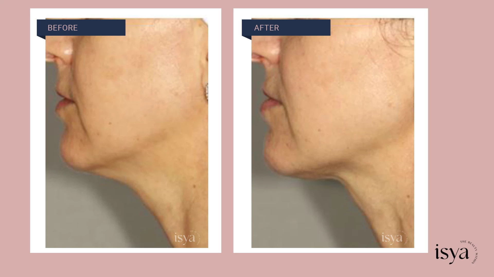 Before - After