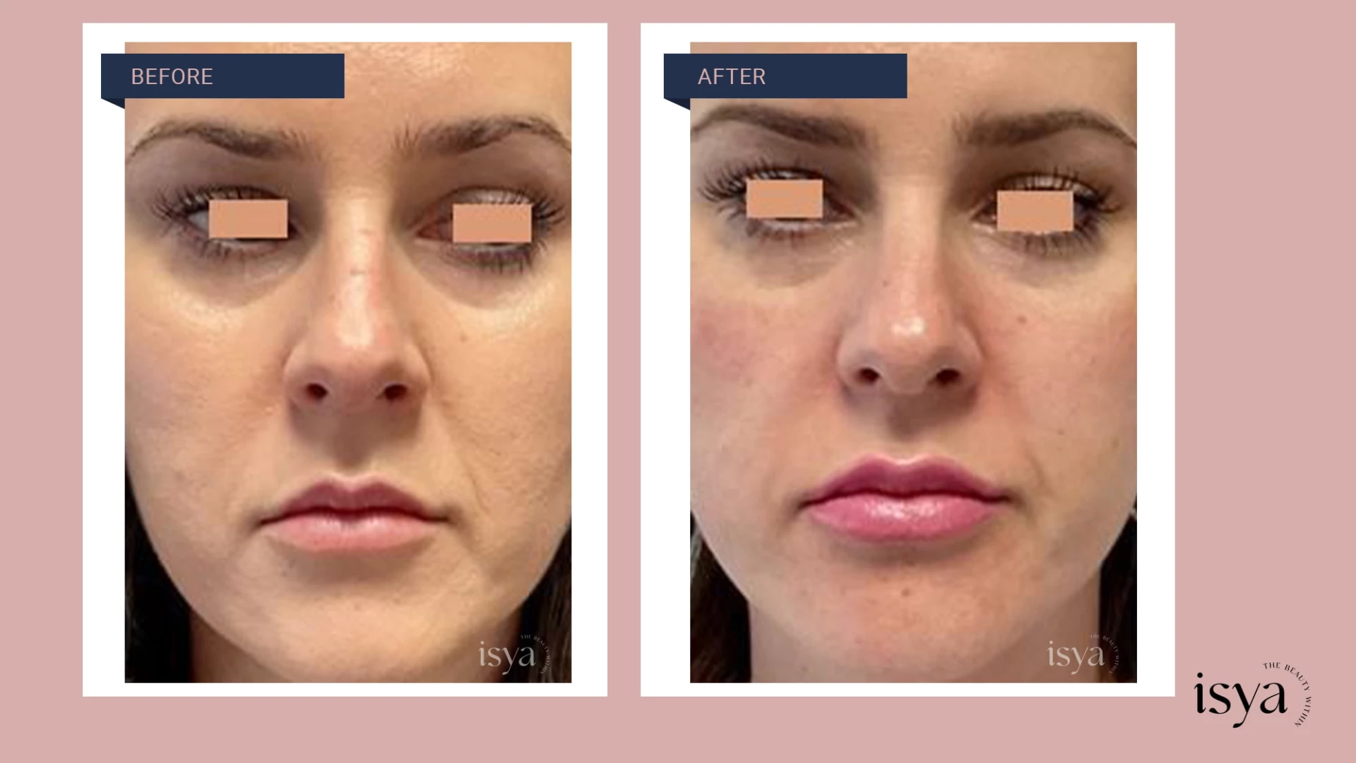 Before - After