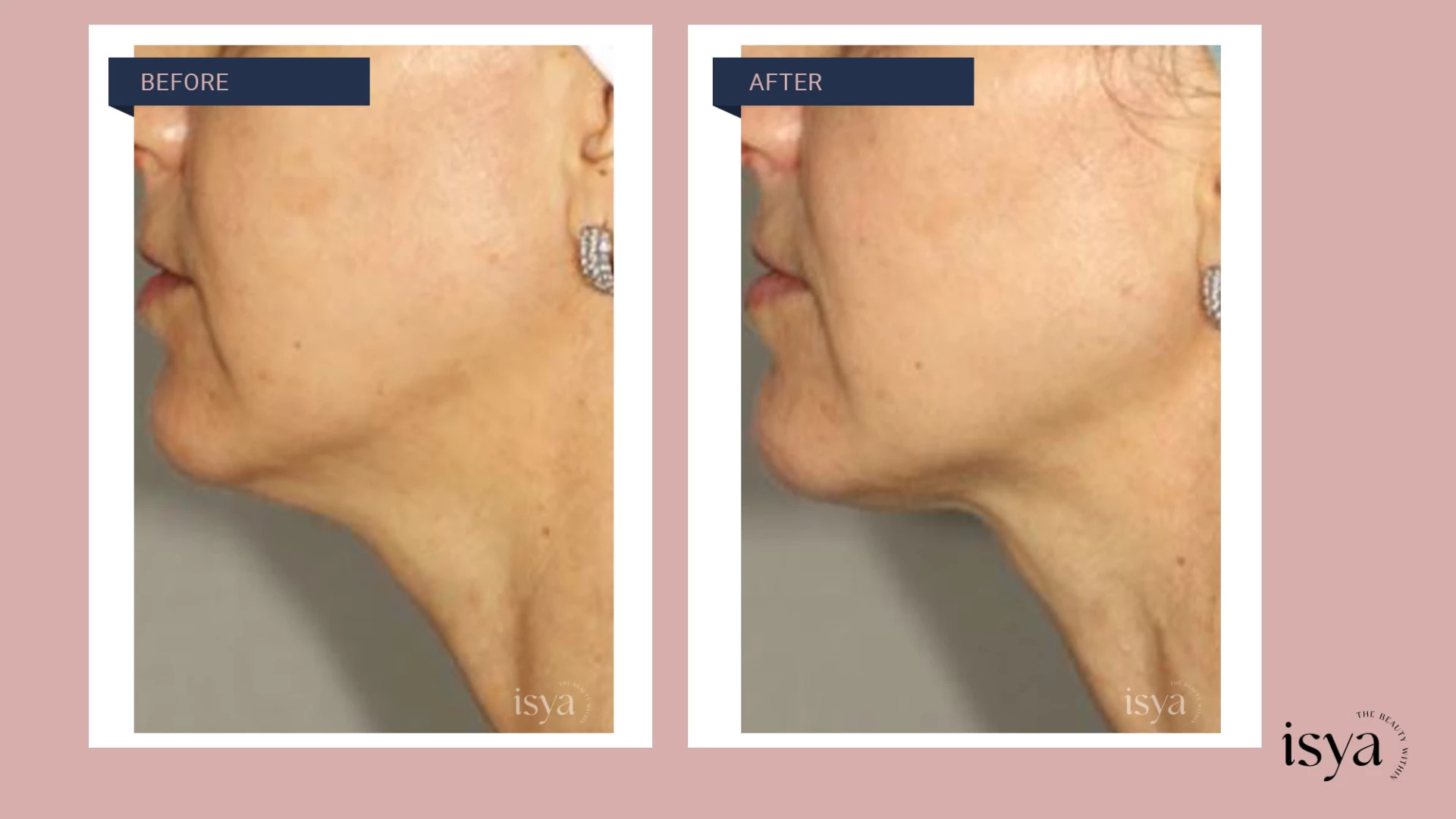 Before - After