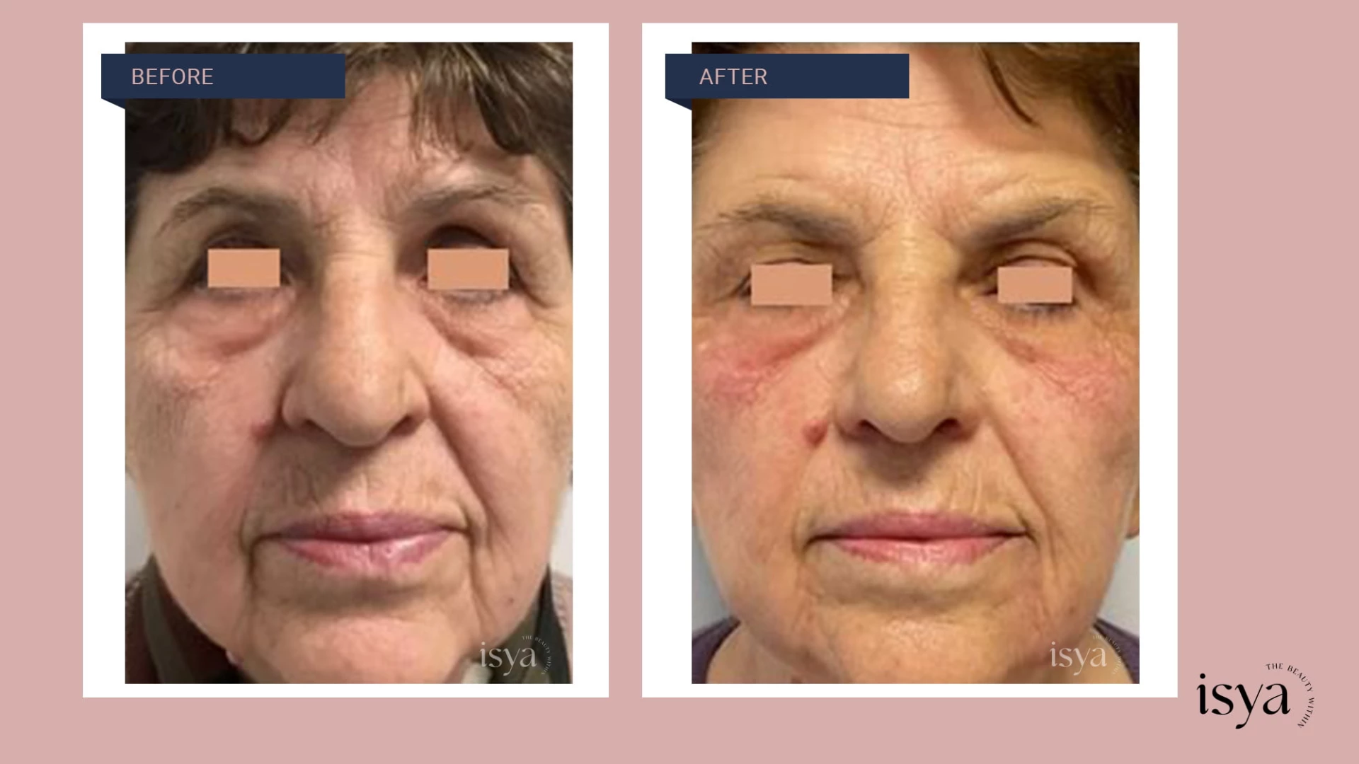 Before - After