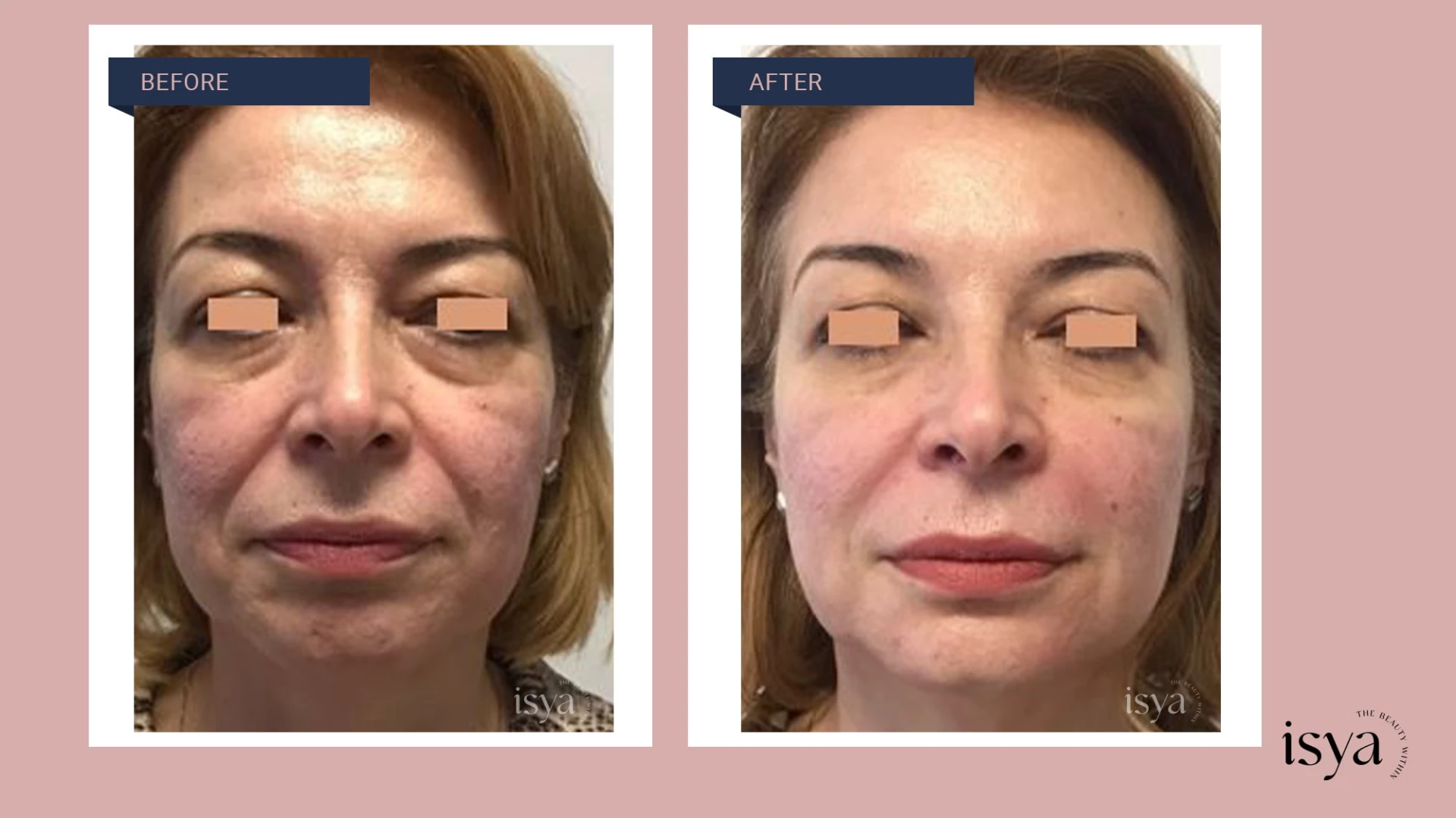 Before - After