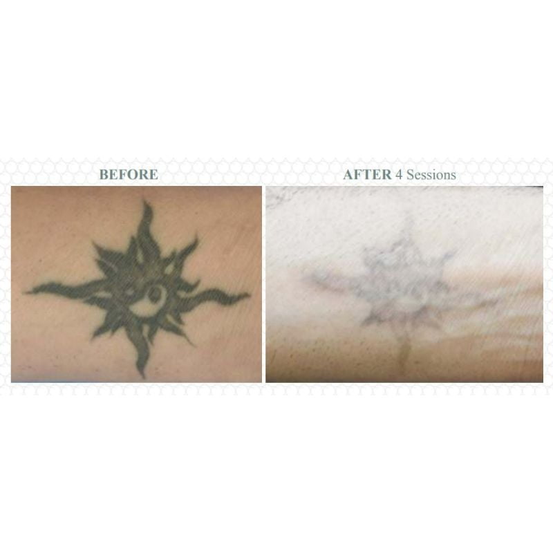 Before & After Image of Tattoo Removal | Isya Aesthetics | Vasant Vihar, New Delhi