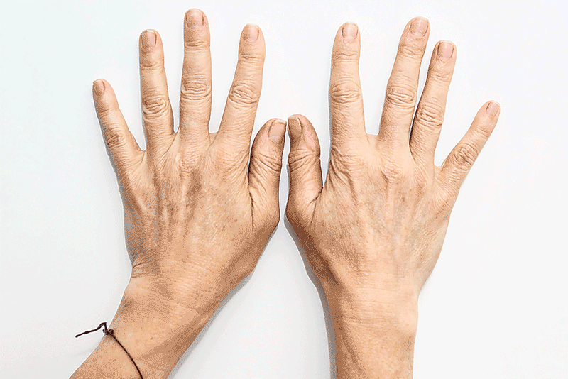 Aging Hands Before & After Treatment | Isya Aesthetics in Vasant Vihar, New Delhi