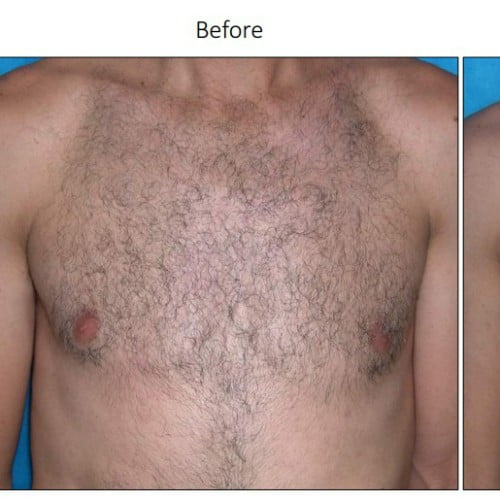 Before Laser hair removal treatment | Isya Aesthetics in Vasant Vihar, New Delhi