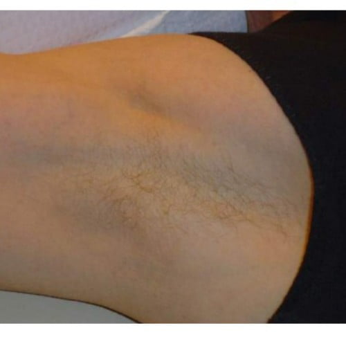 Laser hair removal treatment results | Isya Aesthetics in Vasant Vihar, New Delhi