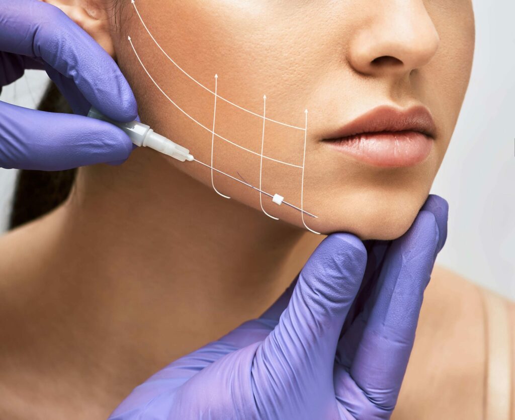 Thread Lift Facial threads are a non-surgical solution for lifting and rejuvenating the skin on the face | Isya Aesthetics in Vasant Vihar, Delhi