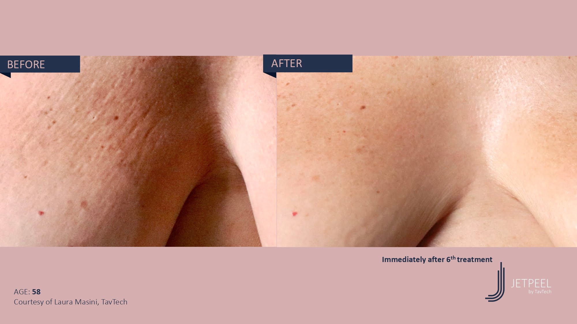 Stretch Marks & Scars before and after effect | Isya Aesthetics | Vasant Vihar, New Delhi