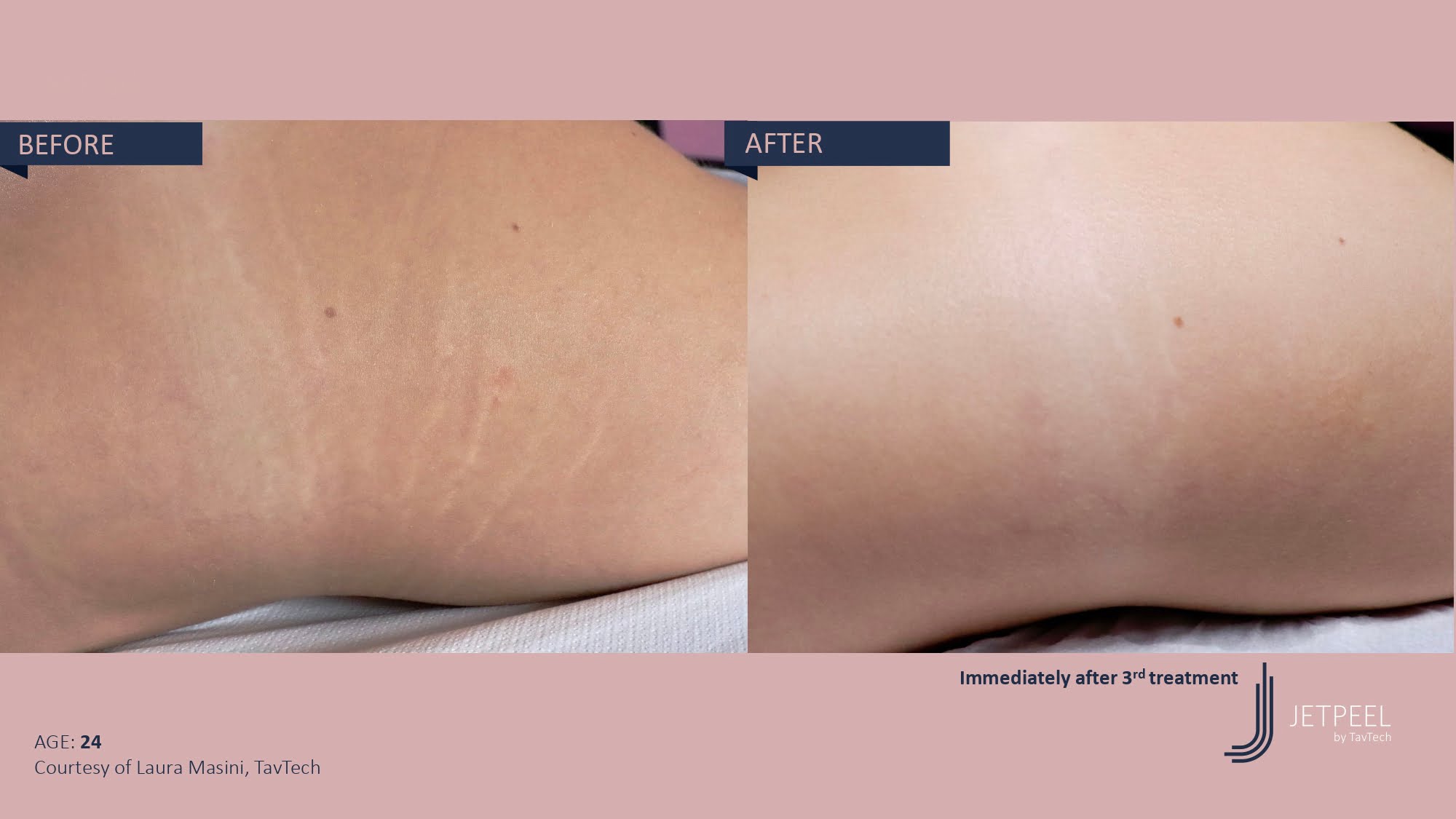 Stretch Marks & Scars before and after effect | Isya Aesthetics | Vasant Vihar, New Delhi