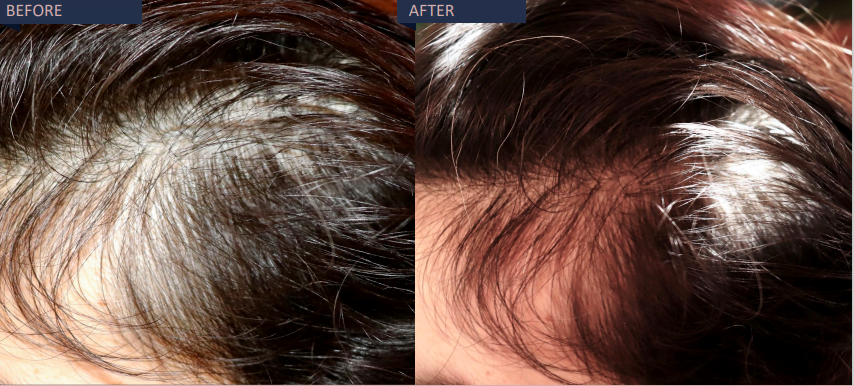 Before and after effect hair growth | Isya Aesthetics | Vasant Vihar, New Delhi