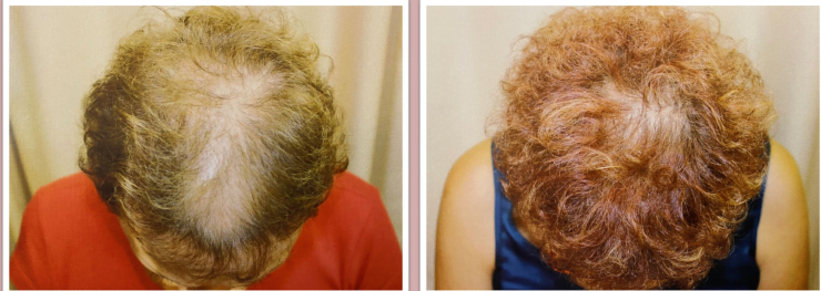 Before and after effect hair growth | Isya Aesthetics | Vasant Vihar, New Delhi