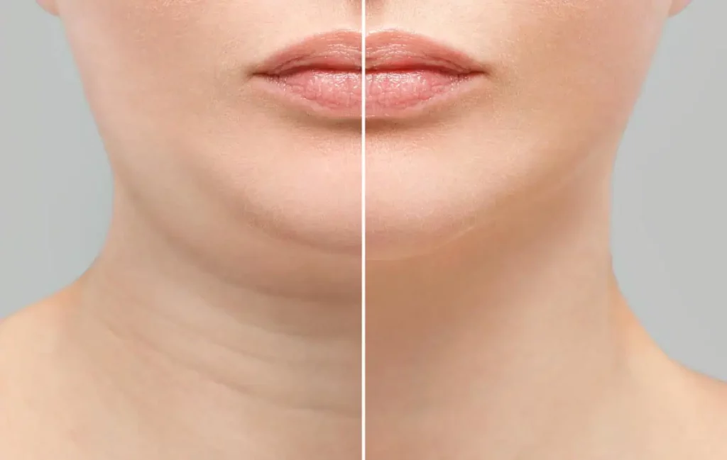 Double-Chin-Treatment-Before-and-After