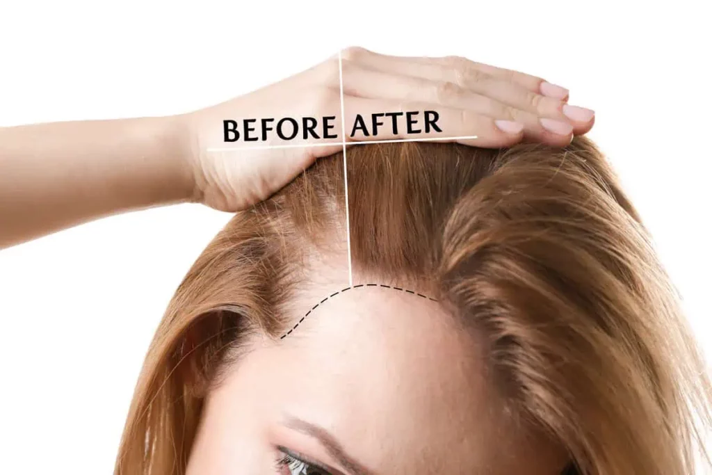 Hair Loss Treatment at Isya Aesthetics